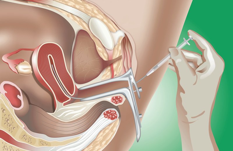 Thụ tinh nhân tạo bằng phương pháp bơm tinh trùng vào buồng tử cung (IUI) là phương pháp điều trị vô sinh đầu tay và được áp dụng từ lâu. 
